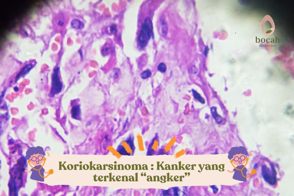 Koriokarsinoma : Kanker yang terkenal&nbsp;“angker”